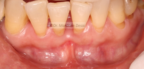 Frenectomy in the lower anterior region…