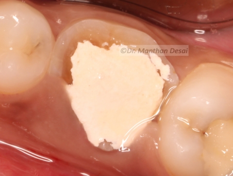 Surgical Crown Lengthening