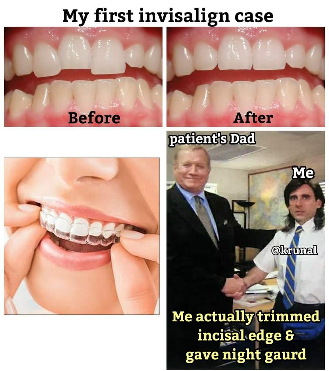 My 1st Invisalign Case