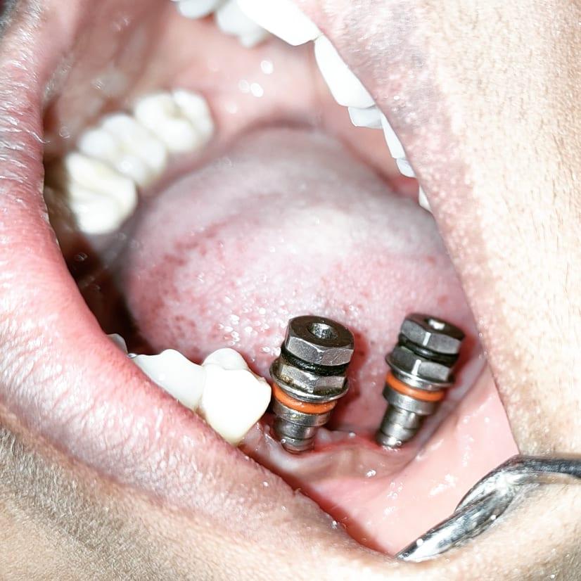 Dental implant