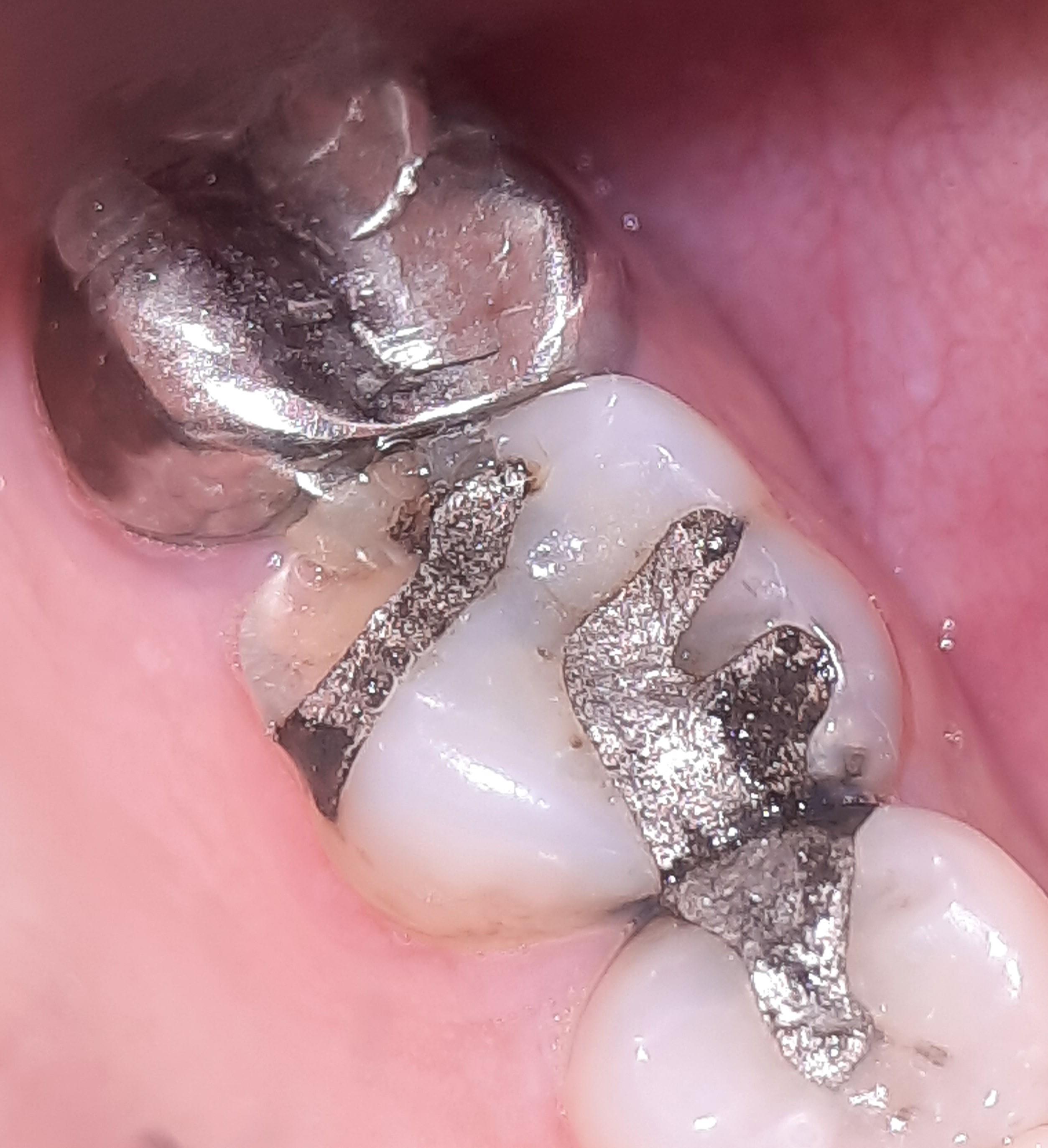 An inlay or a crown ? Pls suggest