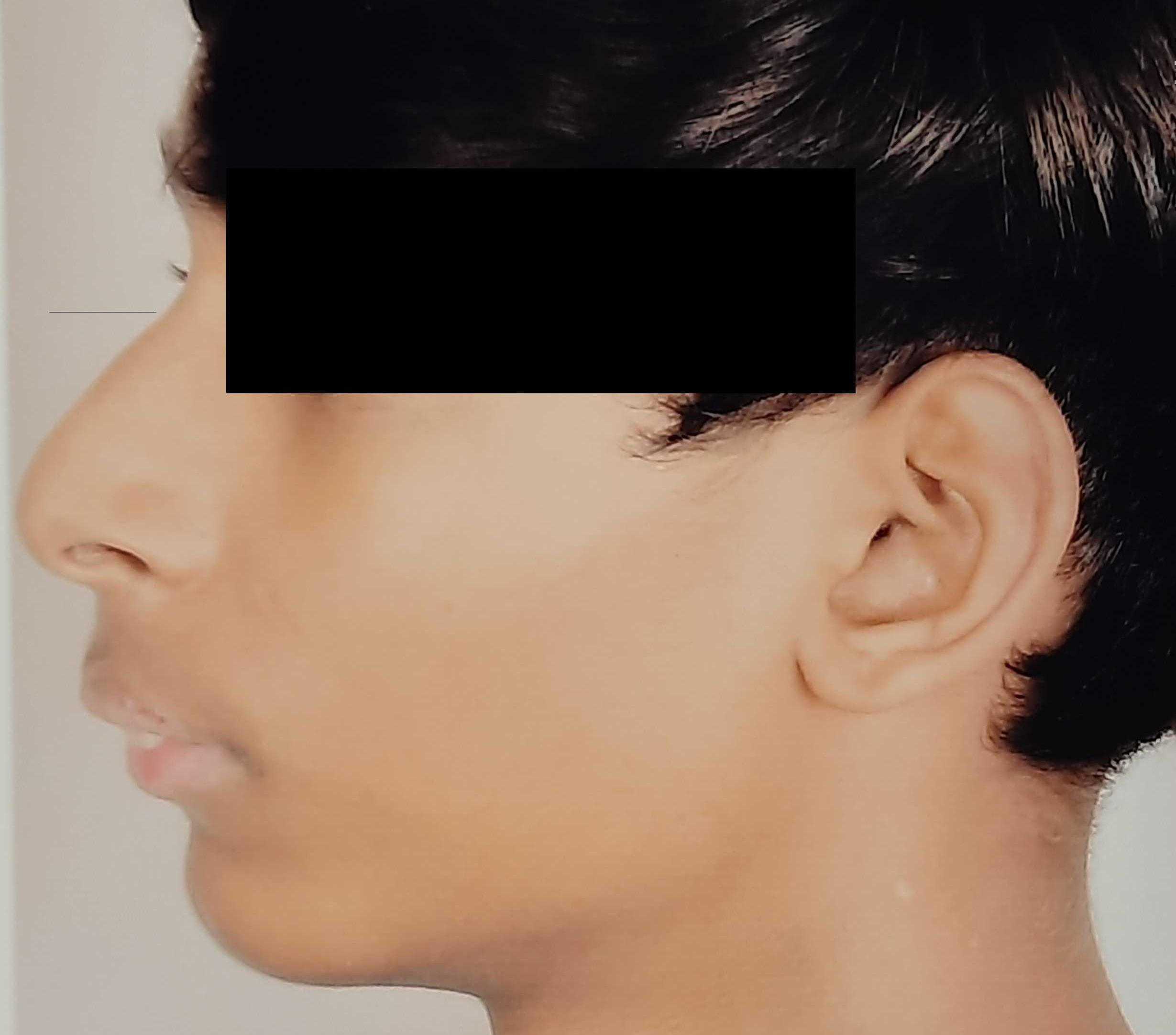 Should surgery be done at 13 years of age ?