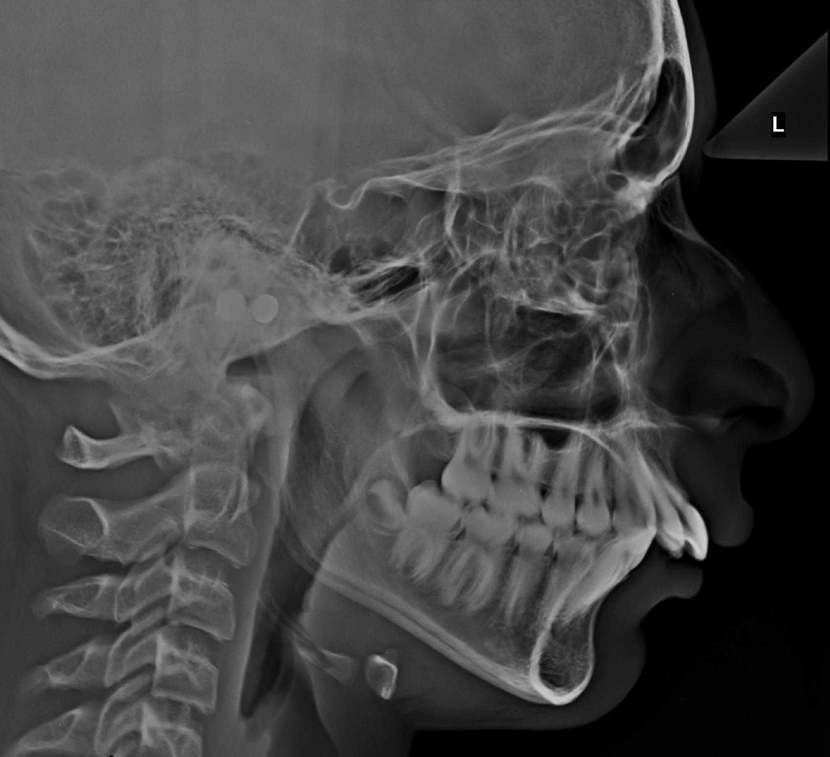 Lateral ceph cropped