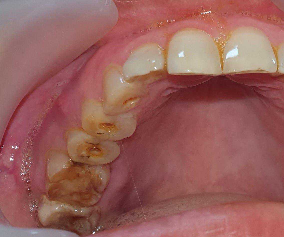 Rehabilatation with zygomatic implants