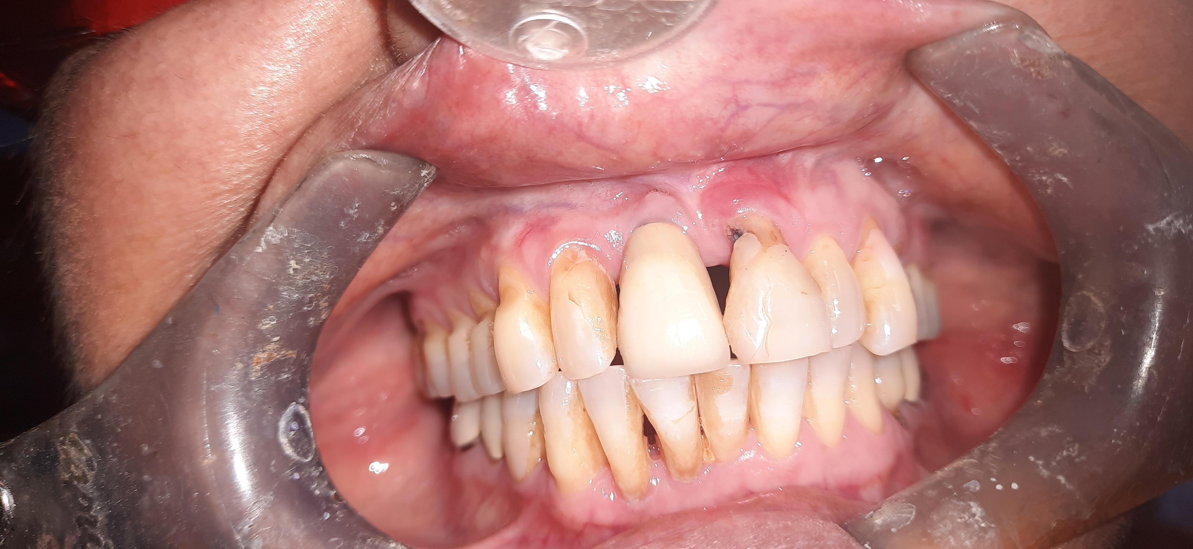 Can an immediate implant be done in this case ?