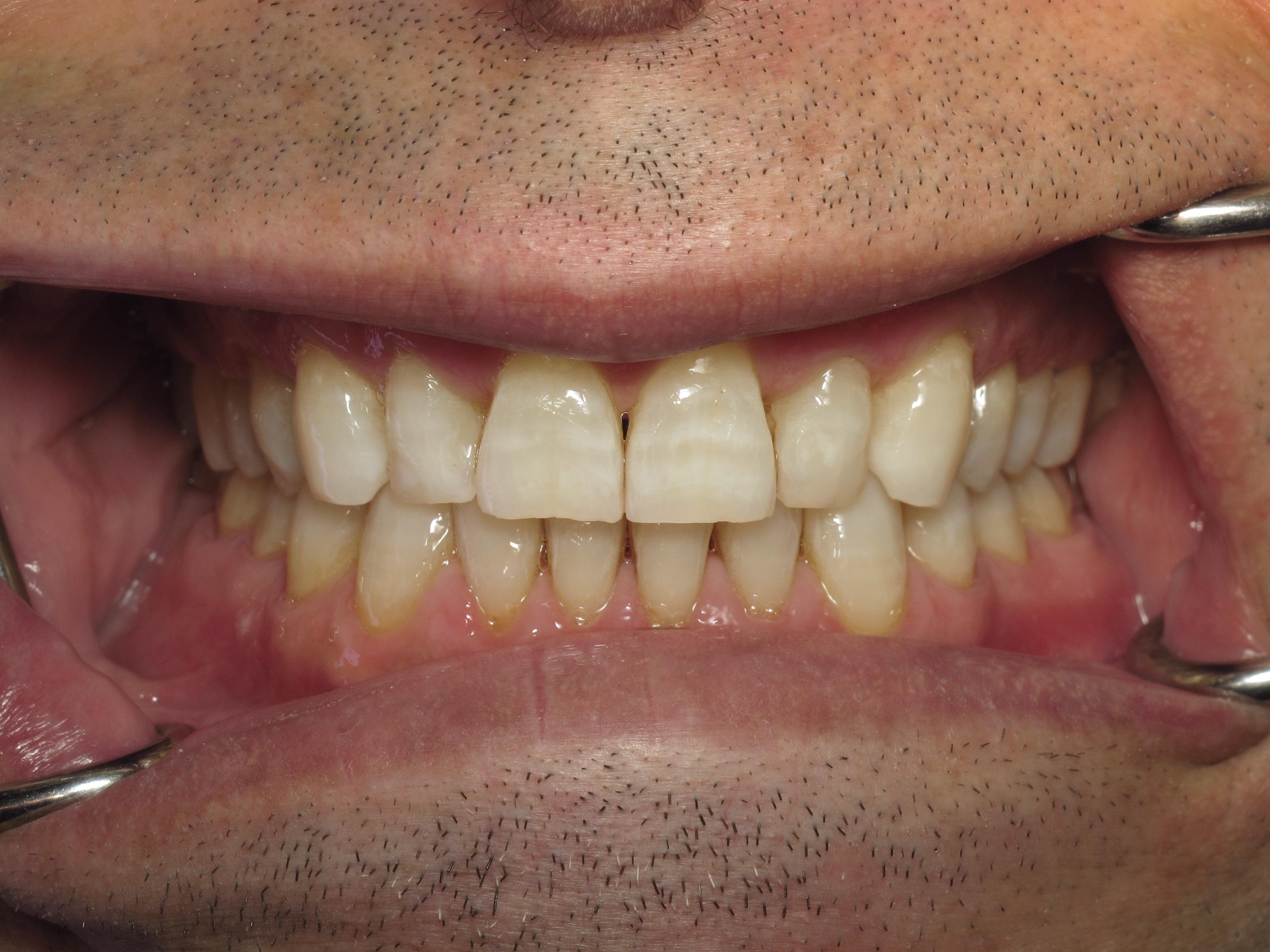 No prep veneers